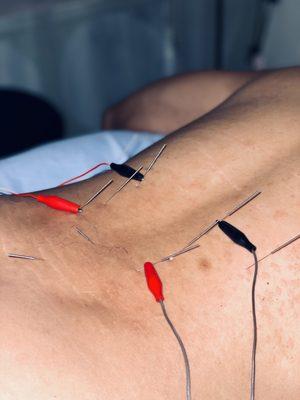 Electro acupuncture on the lower back