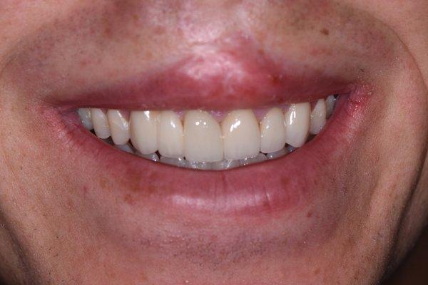 Porcelain bridge to add a missing tooth and crowns used to build smile