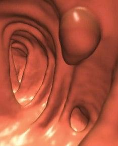 Image from a Virtual Colonoscopy.