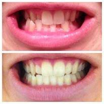 Our patient before and after using Clear Correct invisible braces.  You can change your smile!