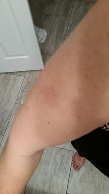 Bruised from the massage