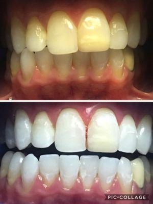 1 hour in office whitening.