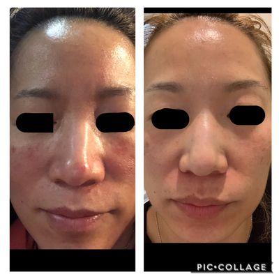 After having the Vivace and Blue toning treatments. Skin texture improved and the tone of the face became even. The pores minimized.