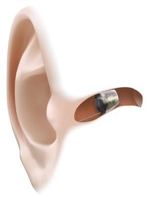 Invisible hearing technology