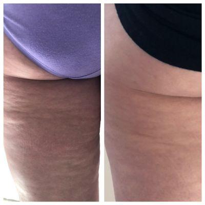 Radiofrequency for cellulite reduction and skin tightening