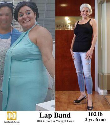 Lap Band Los Angeles Before and After by bariatric surgeon Dr. Davtyan