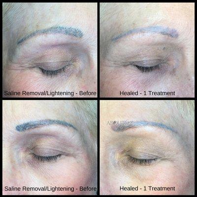 Saline Tattoo Removal can take 3-6 treatments. If done properly, a new brow may be applied at some point.