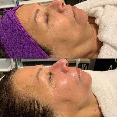 Look at that glow! HydraFacial deep cleans the skin!