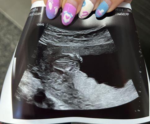 19 week anatomy ultrasound, it's a girl!  Mirarose Arwen