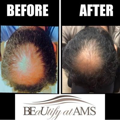 Ask About Our Hair Loss Therapy