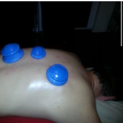 Cupping technique