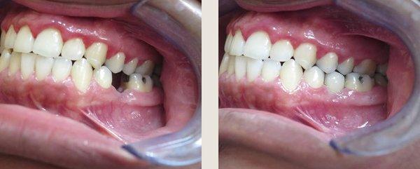 Our dental implants and crowns are a great option for replacing missing teeth.