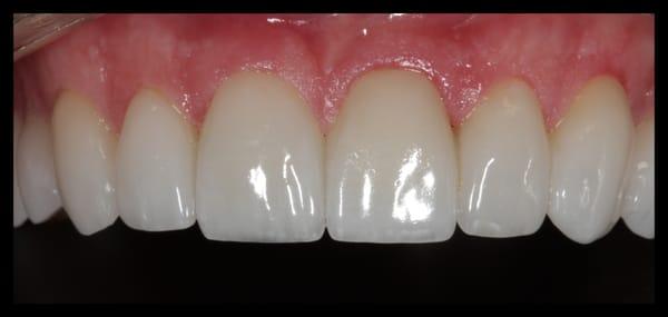 E-max Veneers - Very Strong