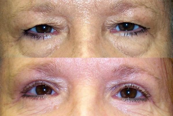 Upper and Lower Blepharoplasty
 www.DrMarkBrown.com 
 Mobile, AL 36609
 251-650-5437