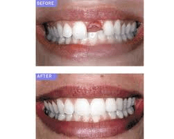 Restore your smile with an implant!!