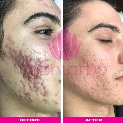 Cystic Acne Transformation