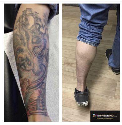 We removed the calf tattoo on the left and are now removing another tattoo for this client.