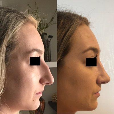 Before and after of rhinoplasty. Amazing!