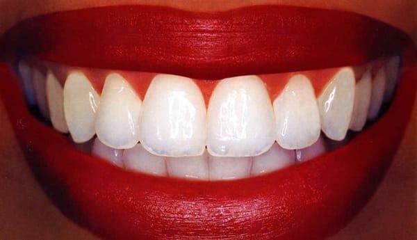 Teeth Whitening in The Woodlands Texas