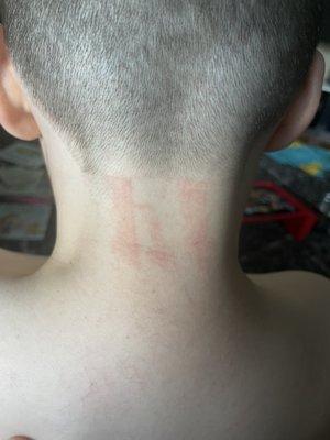 8 year old left with razor burns