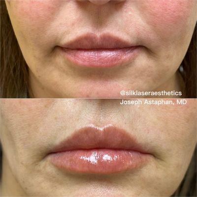 Lip Augmentation