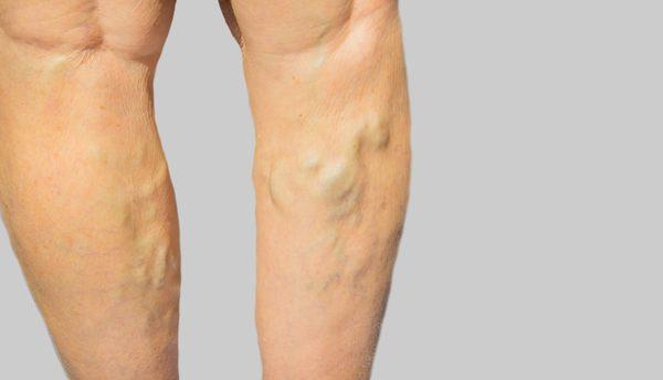 Varicose Veins