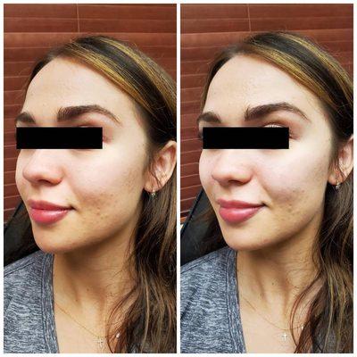 Cheek filler before and after.