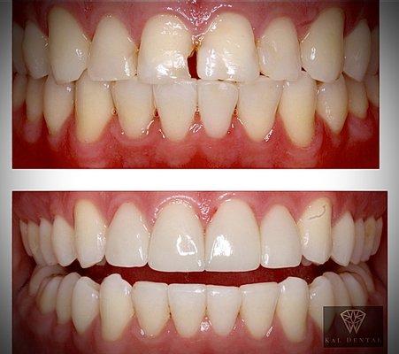 Smile makeover! Patient did whitening and four veneers. Beautiful results!