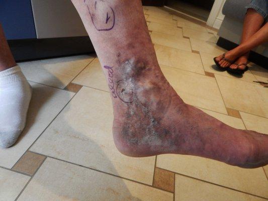 Varicose Vein Treatment