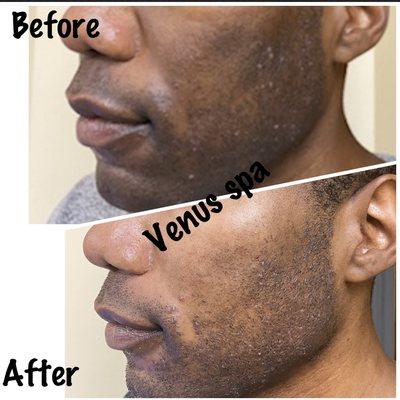 Hyperpigmentation with Chemical Peel