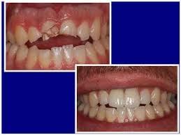 Veneers do wonders!!!