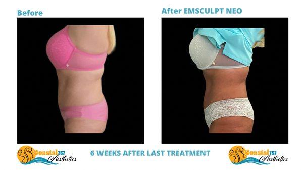 Emsculpt Neo Results