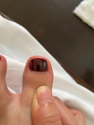 the ugliest my toe has ever looked!!