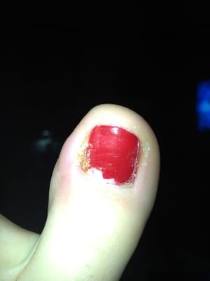 Infected toe nail