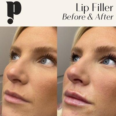 Beautiful Lip Filler by Priscilla