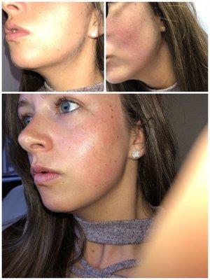 Top before, bottom after. Skin is so smooth, shiny & no peach fuzz. Dermaplaning service.