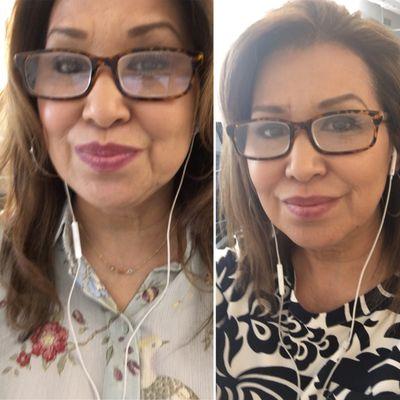 My before and after, from only one visit to Dr Mirza! He advised me on how much to start with, and I already look refreshed! He's THE BEST!