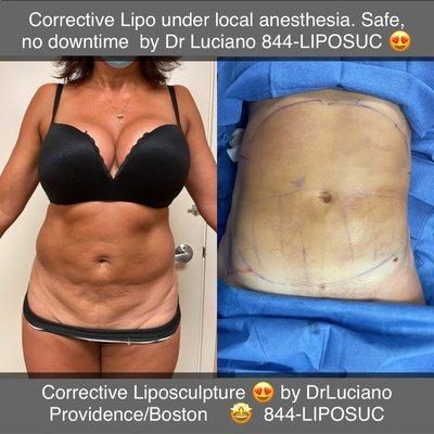 This is a corrective  Vaser liposuction done on an outside patient, and she was thrilled about her results! And so were we. Thank you.