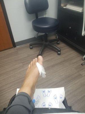 Ingrown toenail (pre op)