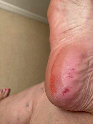 Scraped so much skin from my soles my feet felt burned! Bloodied and bruised.