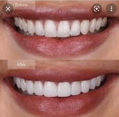 Porcelain veneers