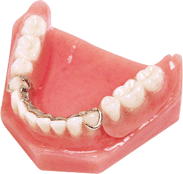 Cast partial denture