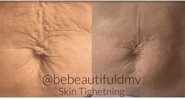 RF skin tightening