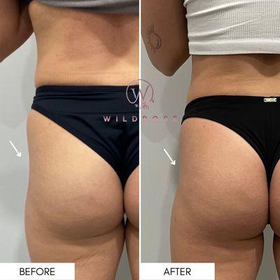 Hip dip volume enhancement with Radiesse