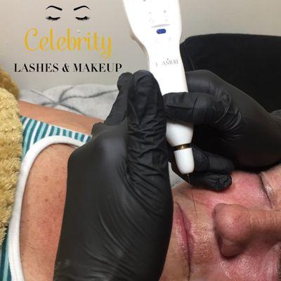 Wrinkle removing treatments