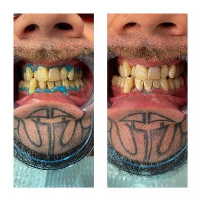 Teeth whitening by Nic