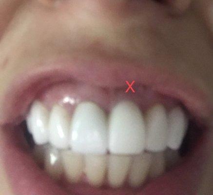 The tooth with the X is Dr. Marchack's work.