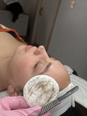 DERMAPLANING FACIAL