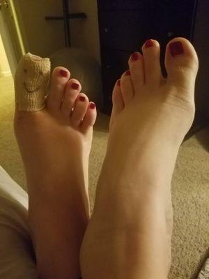 My toe after a partial nail removal for a pedi gone wrong.