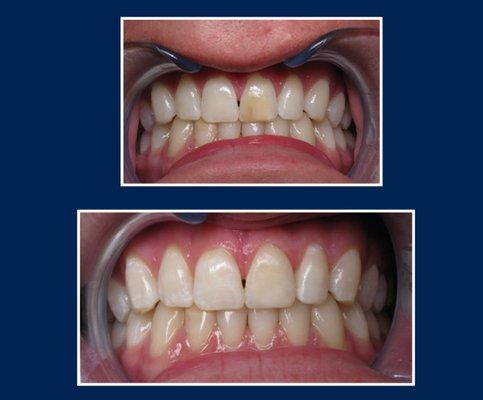 Discolored tooth bothered this young man for a long time. Composite bonding restored his smile.